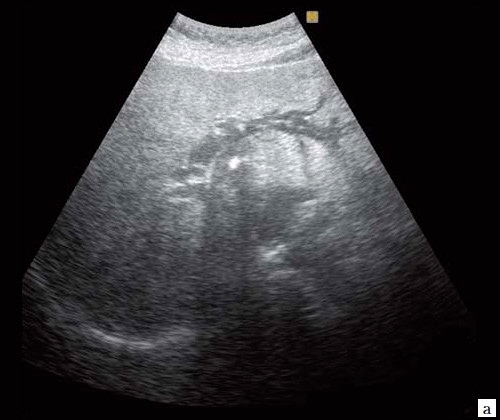 Билиарная гипертензия печени: симптомы, признаки на УЗИ и лечение синдрома