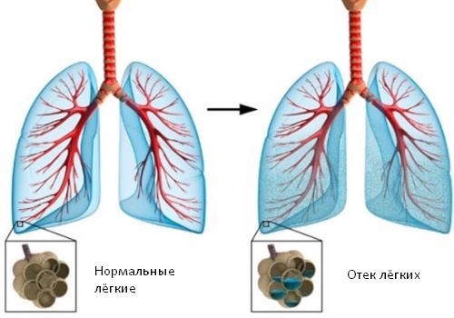 Кашель при сердечной недостаточности - Гипертонии нет