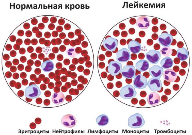 Лейкоз у детей – симптомы