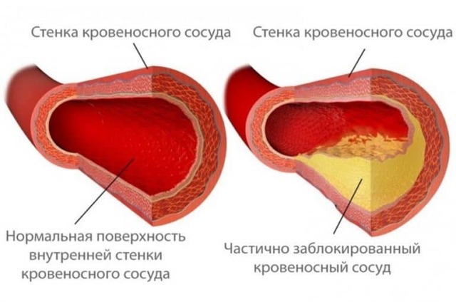 Таблетки и препараты для чистки сосудов головного мозга