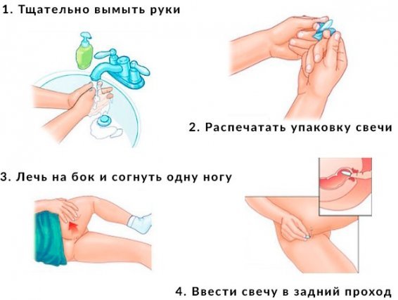 Анестезол свечи: инструкция по применению и для чего они нужны, цена, отзывы, аналоги