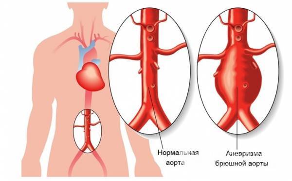 Бифуркация - это раздвоение трахеи, аорты или сонной артерии