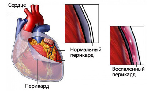 Что делать, если беспокоит жжение в области сердца