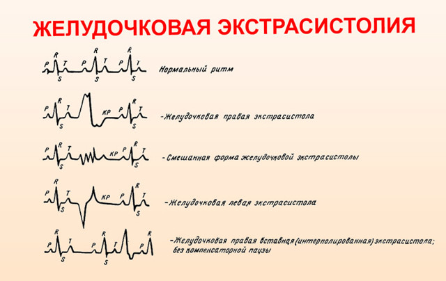 Частая желудочковая экстрасистолия при беременности - Лечение гипертонии