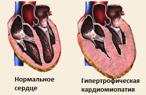 Дисметаболическая кардиомиопатия: симптомы и лечение