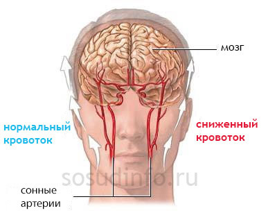 Спазм сосудов головного мозга: симптомы, лечение таблетками, травы снимающие боль и как быстро избавиться от недуга
