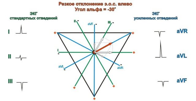 Отклонение эос влево что это такое — Сердце