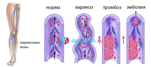 Плохие вены на руках и ногах: что делать