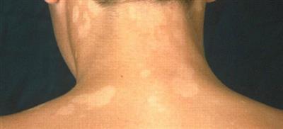 Системная склеродермия - диагностика, лечение, прогноз