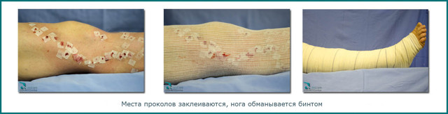 Что важно знать о флебэктомии — операции по удалению вен