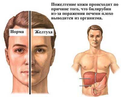 Общий билирубин 23 — Лечим печень