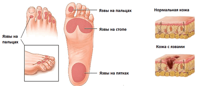 Отекают ноги при сахарном диабете - что делать?