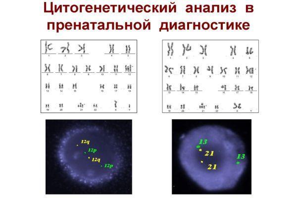 Киста сосудистого сплетения головного мозга: возникновение, диагностика, лечение. Опасна ли киста сосудистого сплетения для новорожденного?