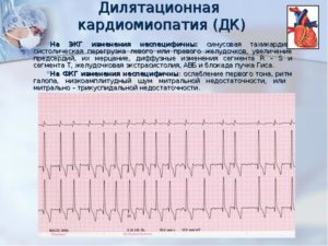 Тахикардия сердца: симптомы, диагностика и лечение - DELFI