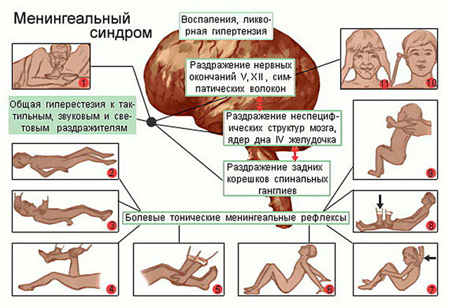 Менингит: симптомы и лечение у детей и взрослых
