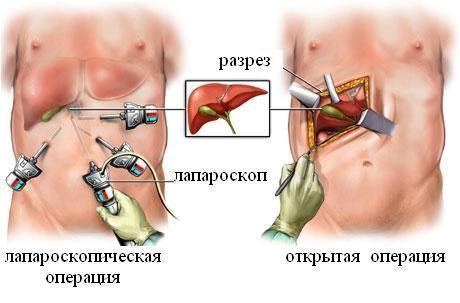 Острый холецистит - виды, симптомы и лечение, неотложная помощь