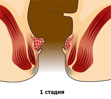 Геморрой - причины, симптомы, диагностика и лечение