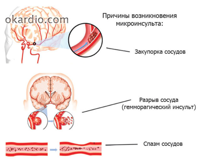 Микроинсульт – симптомы и последствия, признаки, лечение, или Берегите здоровье смолоду