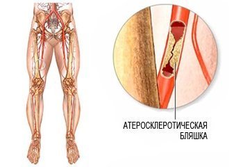 Симптомы и лечение облитерирующего атеросклероза нижних конечностей