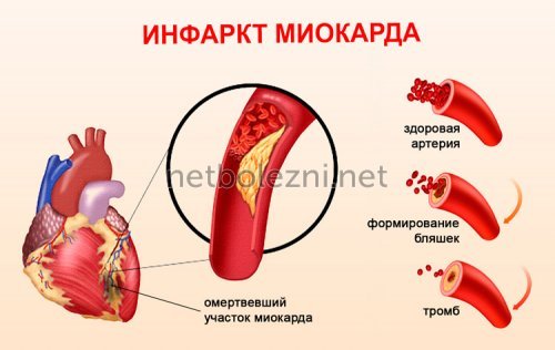 Антикоагулянты – механизм действия, список препаратов