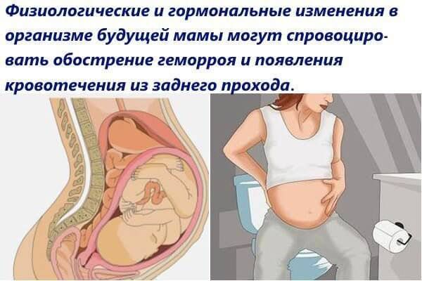 Геморрой при беременности - чем и как лечить геморрой беременной?