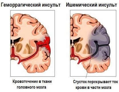 От чего бывает инсульт и почему он происходит
