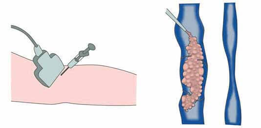 Осложнения и последствия после склеротерапии