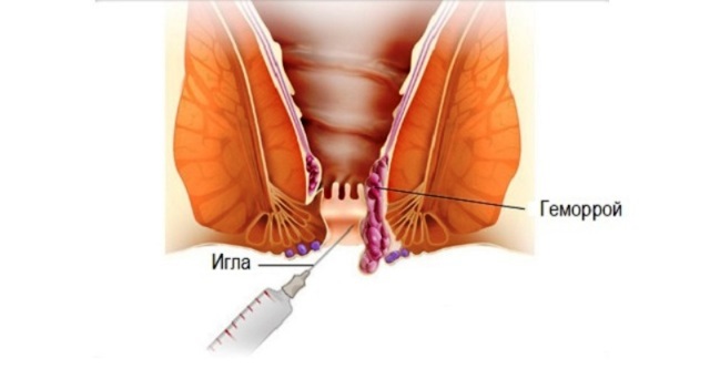 Геморрой при беременности - признаки, симптомы, причины и лечение