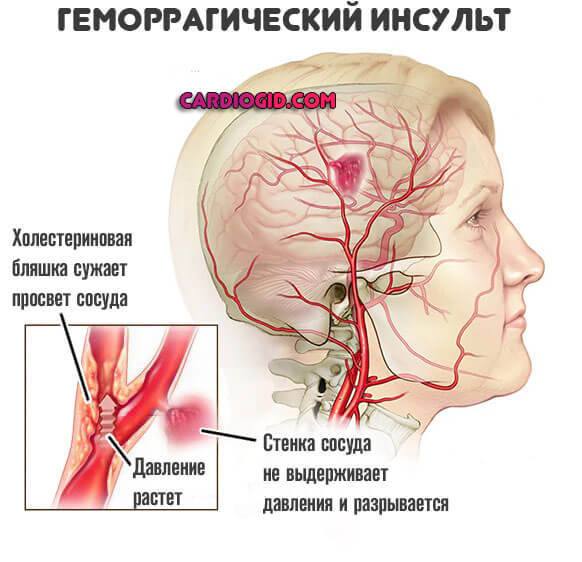Высокое нижнее давление: причины и лечение