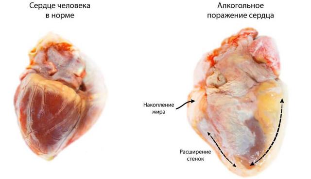 Сердце алкоголика и влияние алкоголя на него