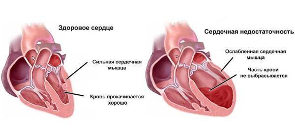 Коньяк повышает или понижает давление, сужает или расширяет сосуды