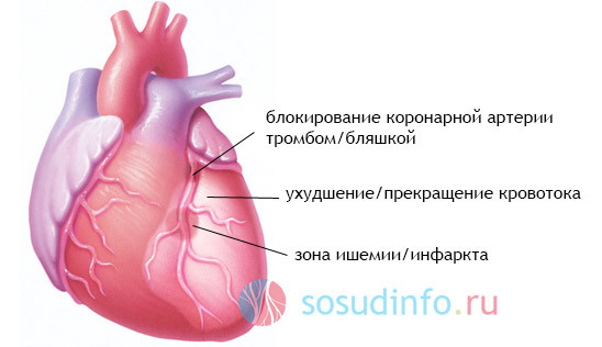 Микроинфаркт у мужчин: симптомы и первые признаки, лечение, последствия