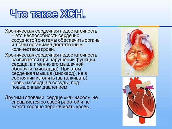 Сердечная недостаточность 2 а