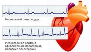 Лекарство от аритмии сердца конкор