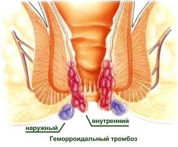 Тромбоз наружного геморроидального узла: причины и лечение