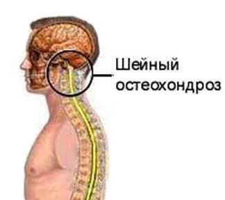 Экстрасистолия при остеохондрозе - что это такое и как лечить