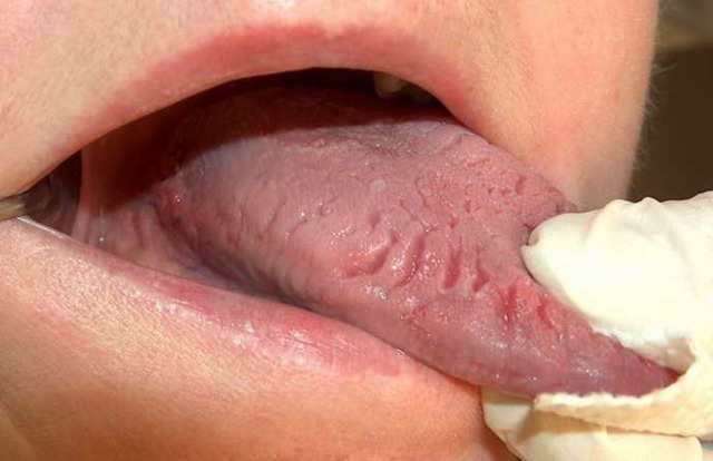 Коричневый налет на языке