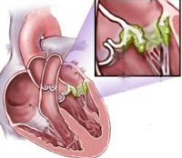 Ревматизм сердца симптомы и лечение — Сердце