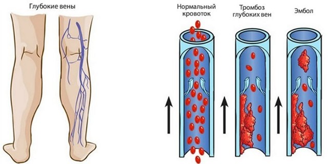 Флебит - что это такое, причины, симптомы, лечение