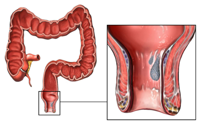 Мазь Левомеколь при геморрое - инструкция