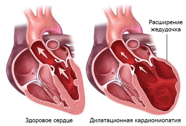 Кардиомиопатия сердца: симптомы и лечение