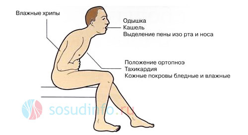 Кардиогенный отек легких - причины, симптомы, диагностика и лечение