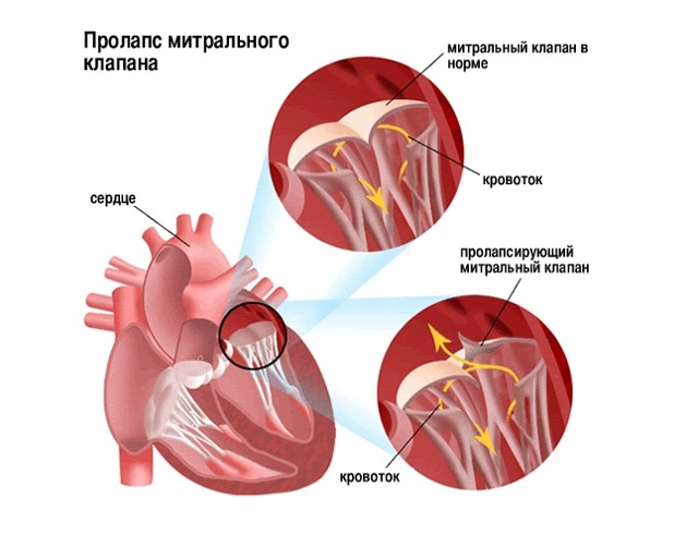 Боли в области сердца при различных заболеваниях - причины, характер, лечение