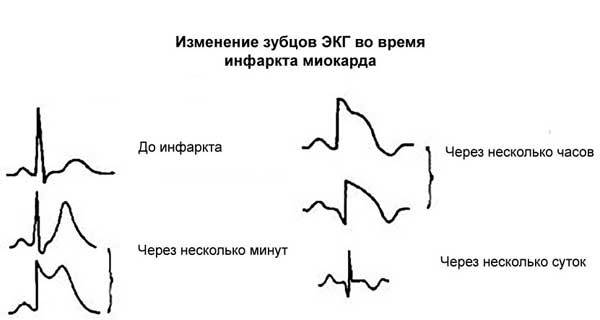 Инфаркт миокарда на ЭКГ: признаки, расшифровка