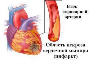Нестенозирующий атеросклероз артерий