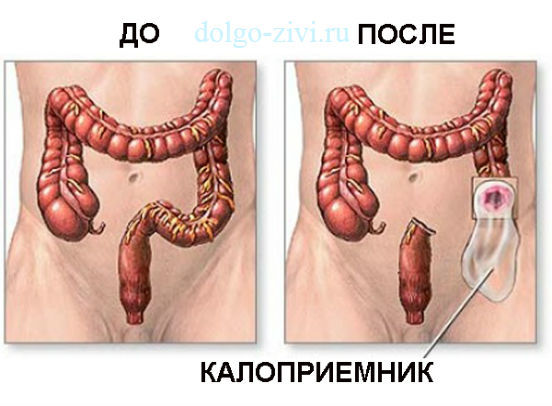 Диета при раке прямой кишки: питание после операции, до операции