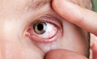 Почему лопнул капилляр в глазу, что делать?