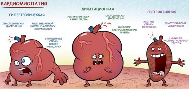 Кардиомиопатия: что это такое, виды, симптомы и лечение