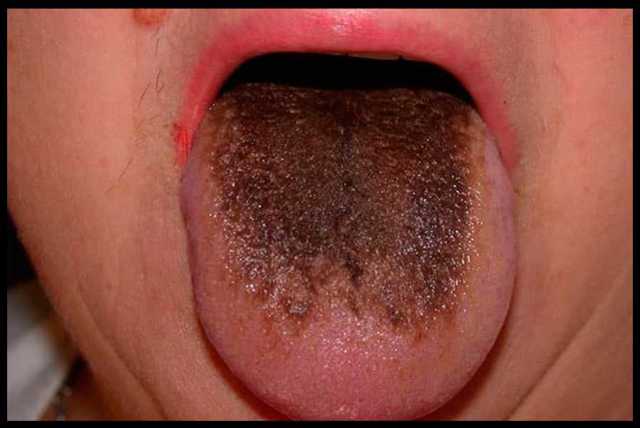 Коричневый налет на языке