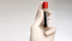 Почему в крови повышен антистрептолизин О? Расшифровка анализа, норма и причины отклонений